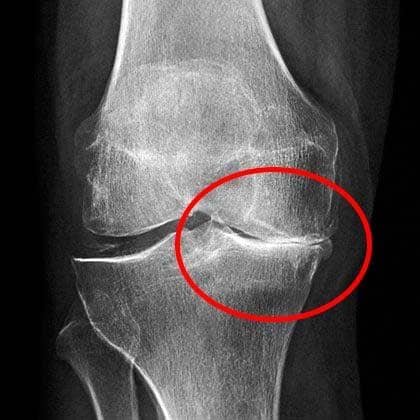 Mujer sufriendo de dolor de rodilla al levantarse