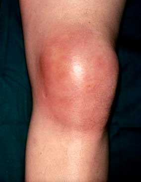 Rodilla inflamada