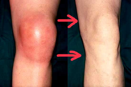 Desinflamación tras usar Sinoflex