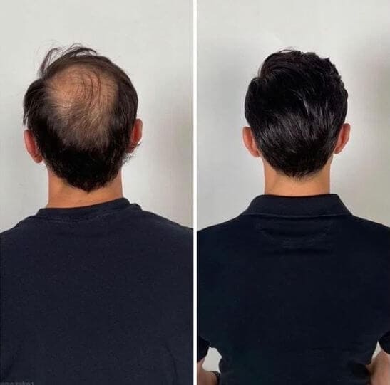 Crecimiento de cabello