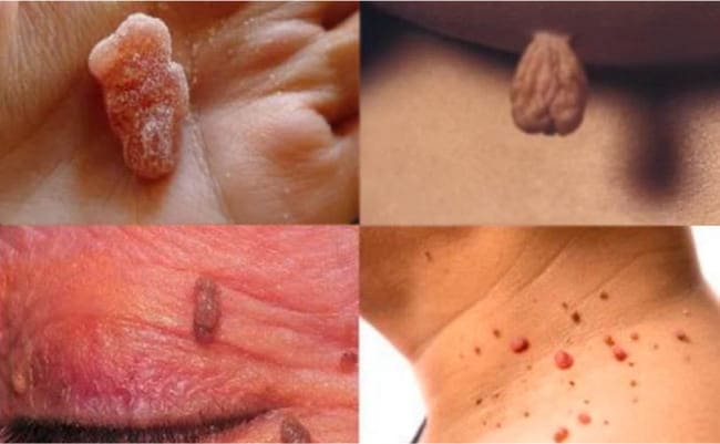 ติ่งเนื้อจากปรสิต